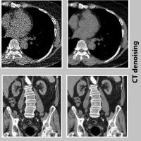 ct_denoising and artifact removal